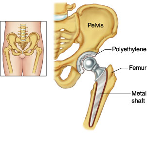 Hip replacement